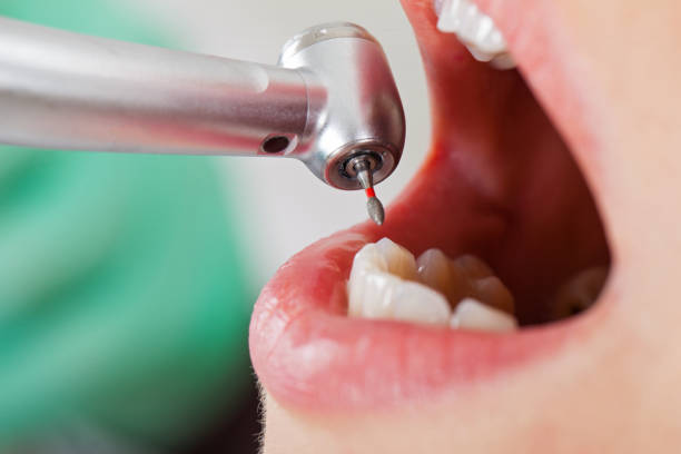 Best Emergency Tooth Extraction in Mclean, TX